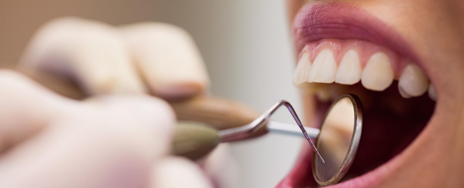 Como remover tártaros e restaurar sua saúde bucal