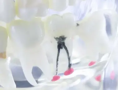 Cárie na raiz do dente: causa, sintomas e tratamentos