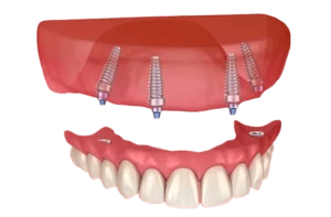 Dentista em Ceilândia realizando implantes dentários