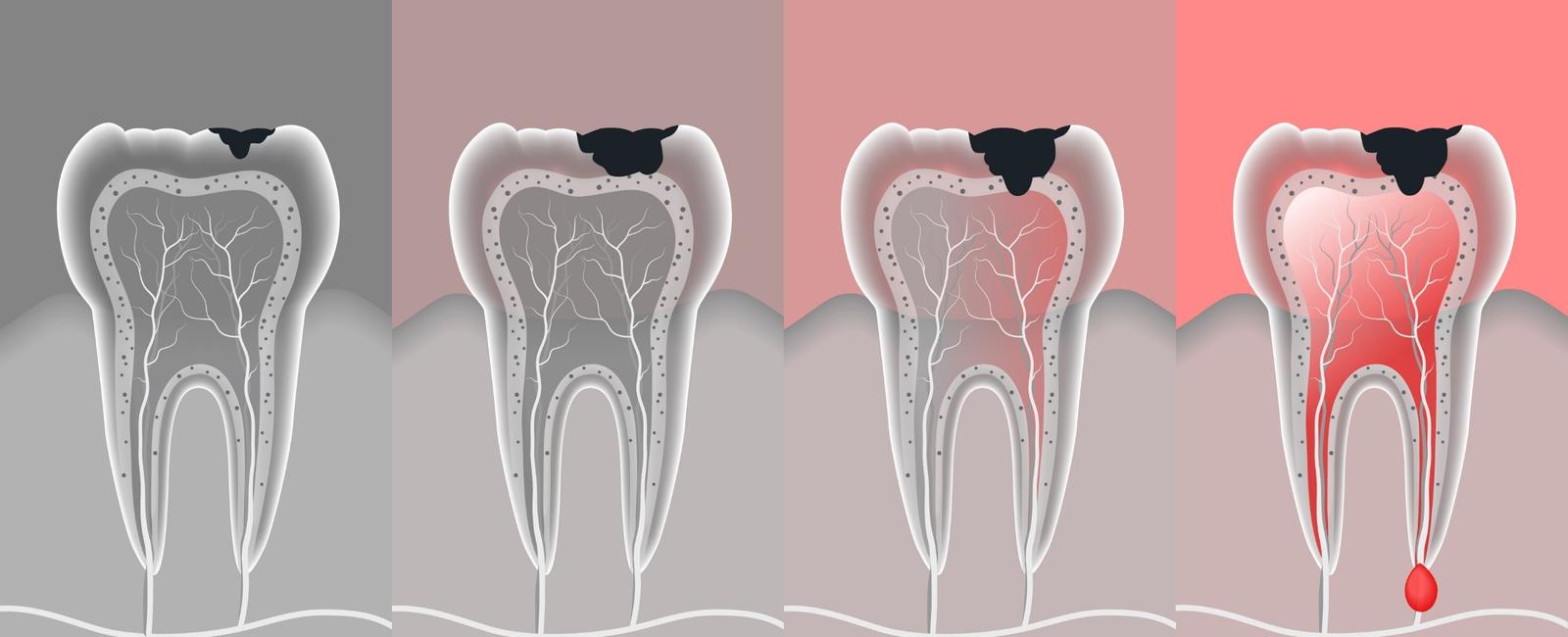 5 cuidados após fazer canal no dente que podem acelerar sua recuperação