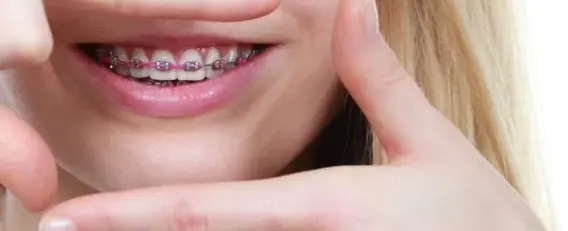 Quanto custa um aparelho dentário? Descubra agora mesmo!
