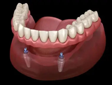 Overdenture: os prós e contras da substituta da dentadura