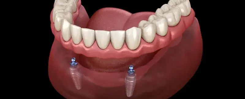 Overdenture: os prós e contras da substituta da dentadura