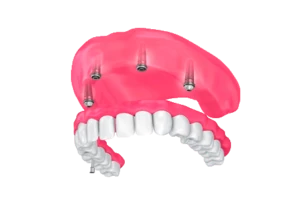 Dentista em Ceilândia realizando implantes dentários