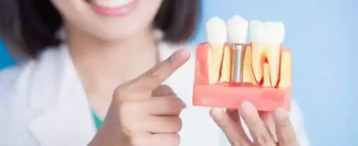 Implante Dentário: o que você não pode deixar de saber sobre esse procedimento