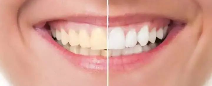 Clareamento Dental: 17 dúvidas mais frequentes respondidas nesse guia completo!