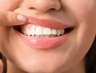 Quanto custa uma gengivoplastia? Tire suas dúvidas aqui!