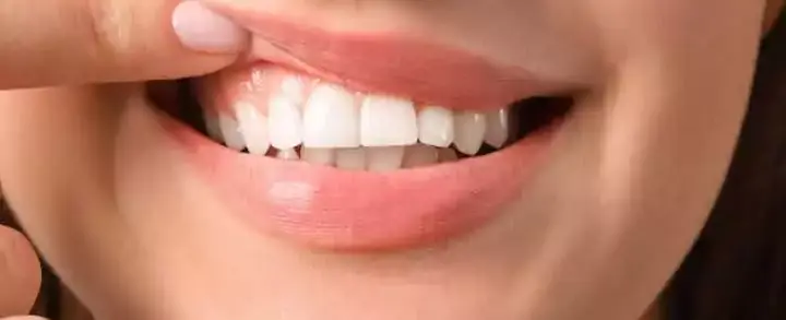 Quanto custa uma gengivoplastia? Tire suas dúvidas aqui!