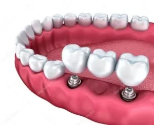 Dentista em Ceilândia realizando implantes dentários