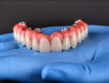 Conheça os tipos de implantes dentários e volte a sorrir!