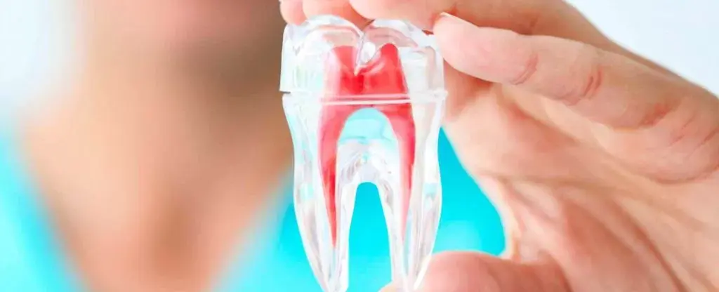 Afinal, o que é fazer canal de dente? Tire suas dúvidas aqui!