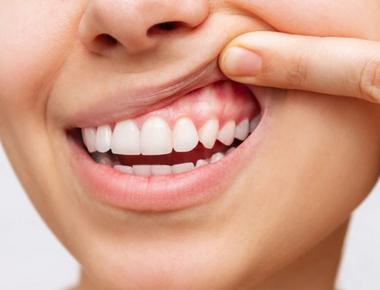 4 doenças da gengiva que merecem sua atenção