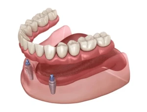 Dentista em Ceilândia realizando implantes dentários