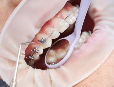 Aparelho bucal: 7 cuidados essenciais para o sucesso do seu tratamento