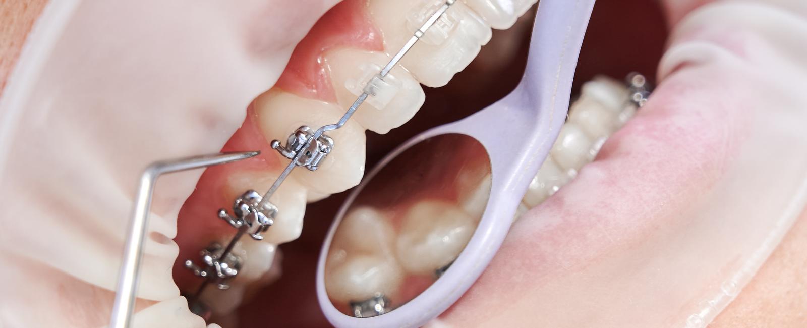 Aparelho bucal: 7 cuidados essenciais para o sucesso do seu tratamento