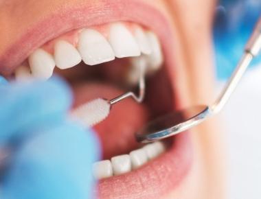 Queimadura na boca: o que fazer para reduzir a dor e acelerar a recuperação?
