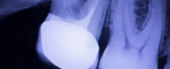 Radiografia do dente: o que é, tipos e quanto custa?