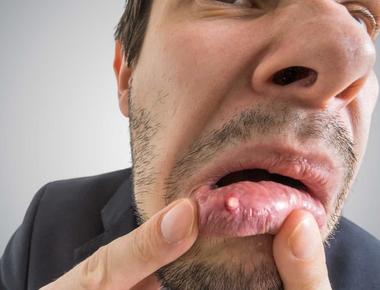 O que é bom para afta na boca? 5 dicas seguras e aprovadas por dentistas