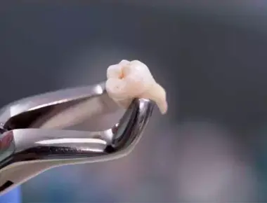 Extração de siso: aprenda tudo sobre a cirurgia do siso e seu pós-operatório