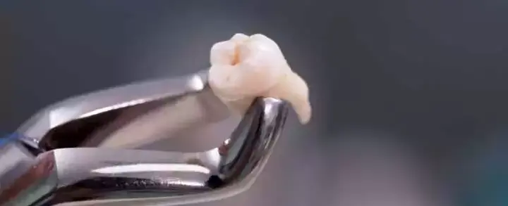 Extração de siso: aprenda tudo sobre a cirurgia do siso e seu pós-operatório