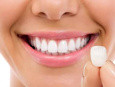 Lentes e Facetas: entenda as diferenças e conquiste o sorriso perfeito!