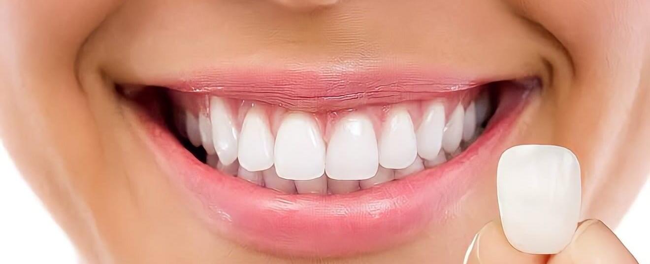 Lentes e Facetas: entenda as diferenças e conquiste o sorriso perfeito!