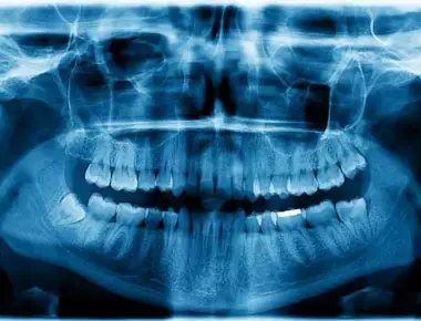 Panorâmica dos dentes: conheça o exame e sua importância
