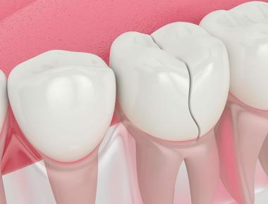 Dente quebrado? Veja como resolver essa emergência odontológica!