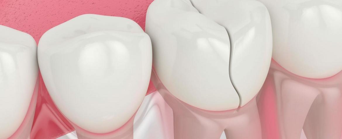 Dente quebrado? Veja como resolver essa emergência odontológica!