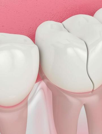 Dente quebrado? Veja como resolver essa emergência odontológica!