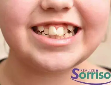 Dente encavalado: conheça as causas, consequências e o tratamento