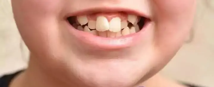 Dente encavalado: conheça as causas, consequências e o tratamento