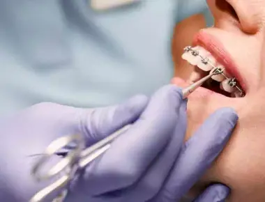 Manutenção do aparelho: 5 razões para não faltar às consultas