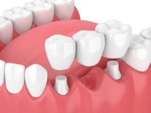 Dentista em Ceilândia realizando implantes dentários